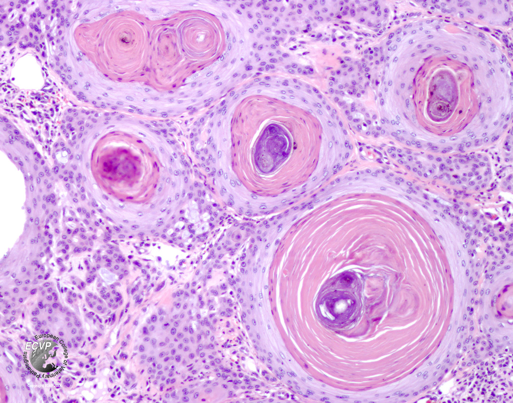 Squamous-cell-carcinoma1